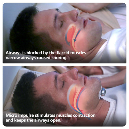 Stop Snoring Tonight™ – Smart Anti-Snore Device with Sleep Tracking & Instant Relief
